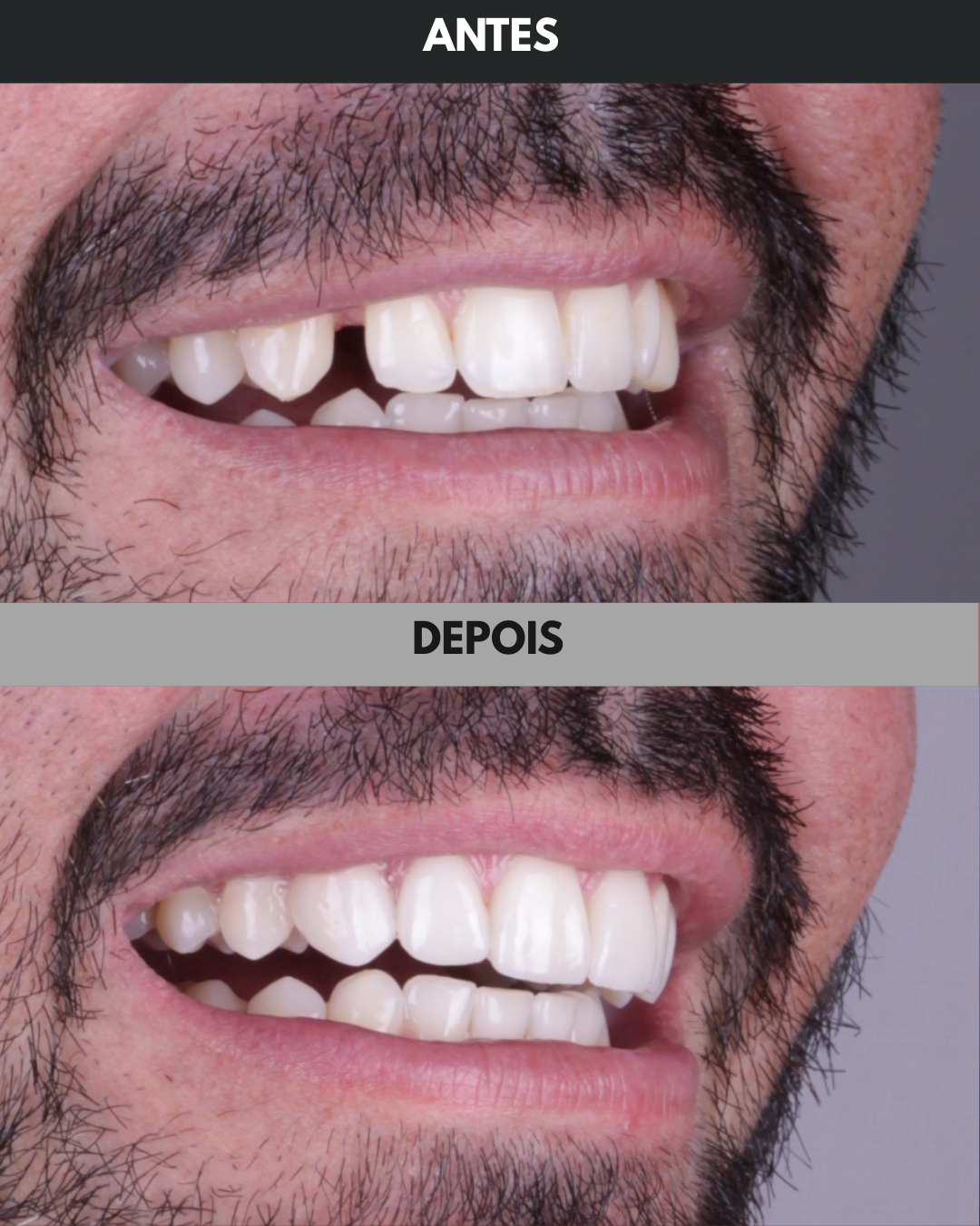 Antes e Depois - 01